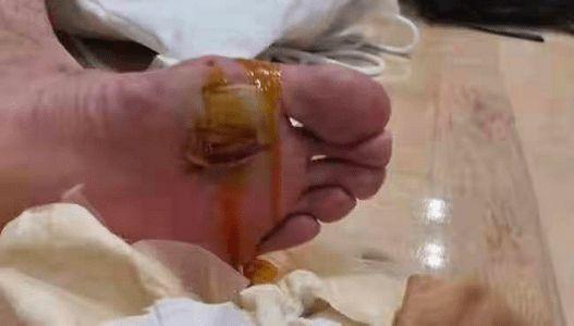 看着都疼!谌龙脚底的血泡触目惊心,带伤坚持为国羽拼回奥运银牌